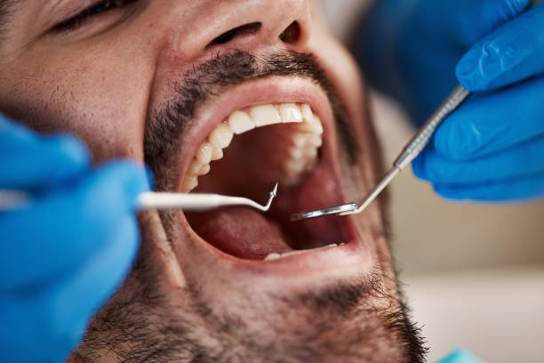 Best Broken or Chipped Tooth Repair in Baldwin, GA
